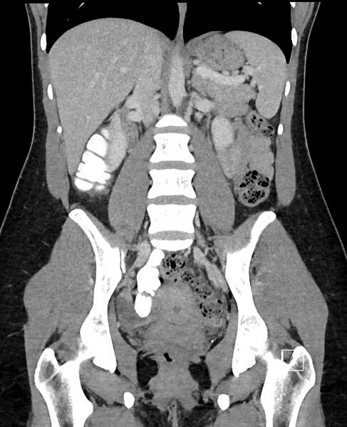File:Acute uncomplicated appendicitis (Radiopaedia 61374-69304 Coronal C+ portal venous phase 60).jpg