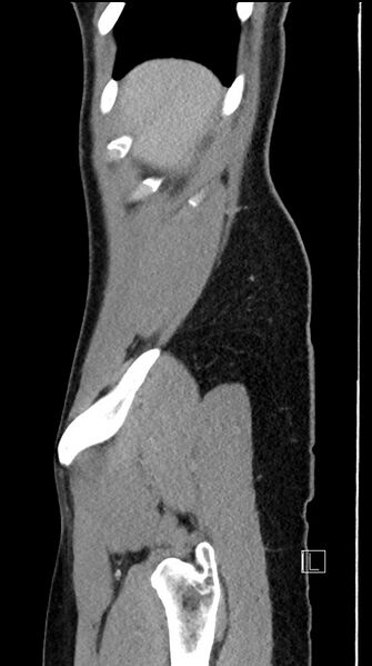 File:Acute uncomplicated appendicitis (Radiopaedia 61374-69304 Sagittal C+ portal venous phase 92).jpg