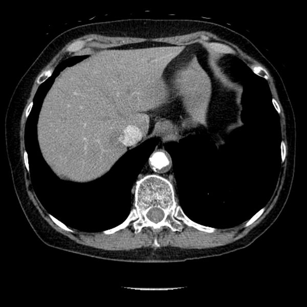 File:Adenocarcinoma of the lung (Radiopaedia 41015-43755 Axial C+ portal venous phase 106).jpg