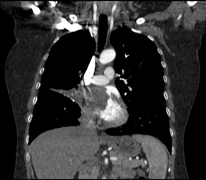 File:Adenocarcinoma of the lung (Radiopaedia 44205-47803 Coronal C+ portal venous phase 40).jpg