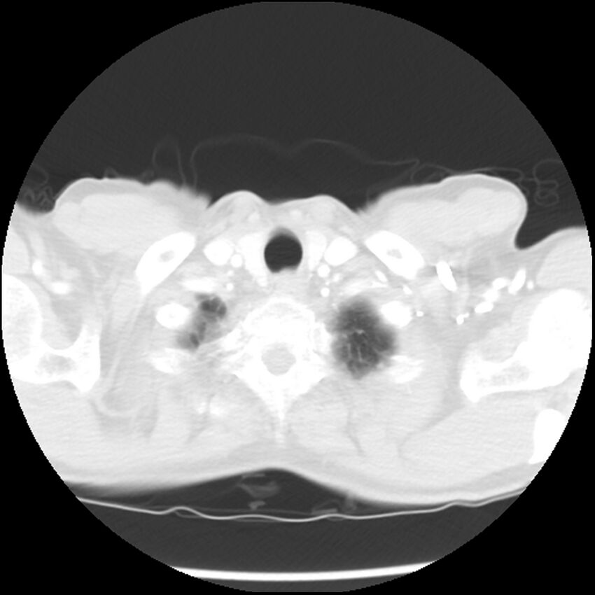 Adenocarcinoma of the lung - micropapillary predominant (Radiopaedia 42446-45563 Axial lung window 4).jpg