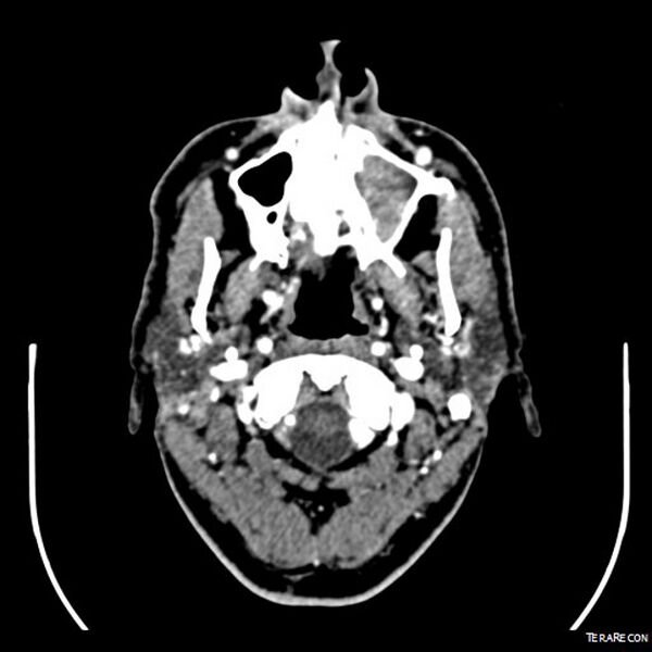 File:Adenoid cystic carcinoma involving paranasal sinus (Radiopaedia 16580-16283 Axial C+ arterial phase 8).jpeg