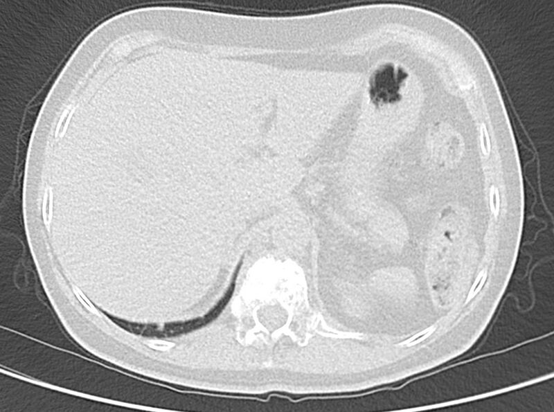File:Adenosquamous lung carcinoma (Radiopaedia 22035-22030 lung window 57).jpg