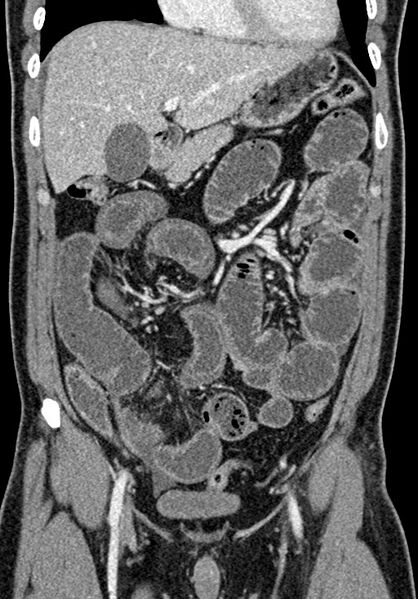 File:Adhesional small bowel obstruction (Radiopaedia 58900-66131 Coronal C+ portal venous phase 111).jpg