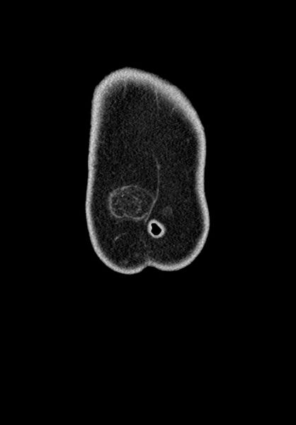 File:Adhesional small bowel obstruction (Radiopaedia 58900-66131 Coronal C+ portal venous phase 45).jpg