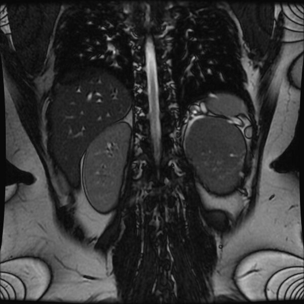 File:Adrenal cortical carcinoma (Radiopaedia 70906-81116 Coronal FIESTA 26).jpg