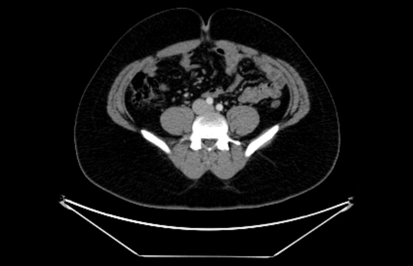 Adrenocortical carcinoma (Radiopaedia 80134-93438 Axial C+ portal venous phase 85).jpg