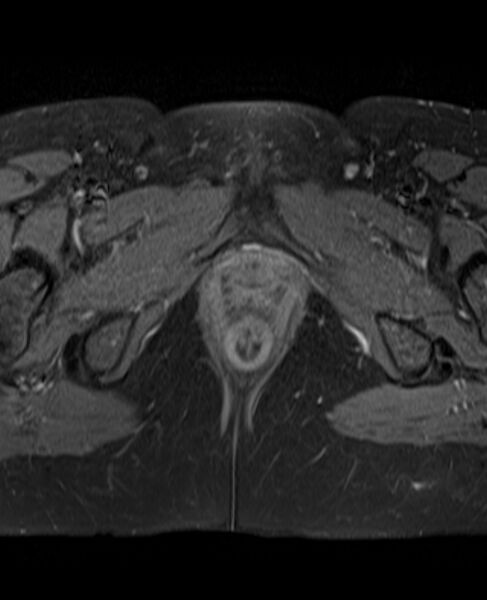 File:Adult granulosa cell tumor of the ovary (Radiopaedia 71581-81950 Axial T1 C+ fat sat 26).jpg
