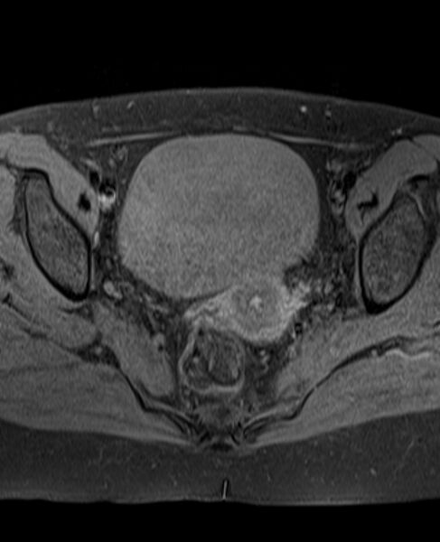 File:Adult granulosa cell tumor of the ovary (Radiopaedia 71581-81950 Axial T1 fat sat 16).jpg