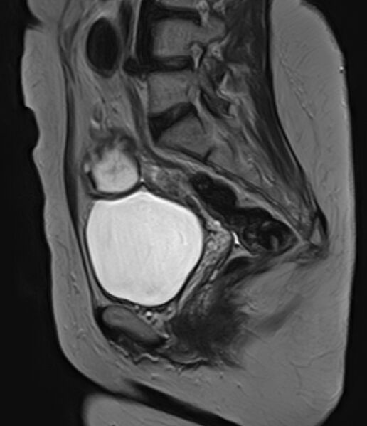 File:Adult granulosa cell tumor of the ovary (Radiopaedia 71581-81950 Sagittal T2 10).jpg
