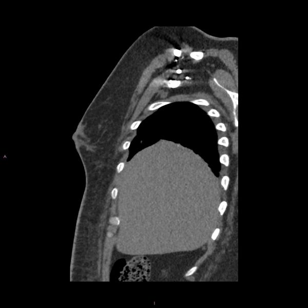 File:Agenesis of the left hepatic lobe (Radiopaedia 77284-89359 Sagittal C+ CTPA 14).jpg