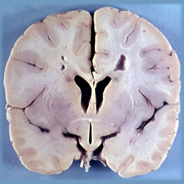 File:Alexander disease (gross pathology) (Radiopaedia 36363).jpg