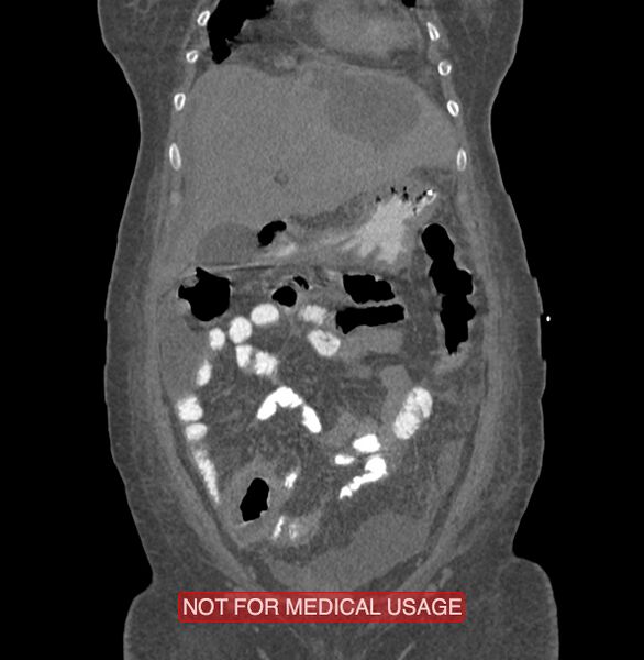 File:Amoebic enterocolitis with liver abscess (Radiopaedia 35100-36609 B 38).jpg