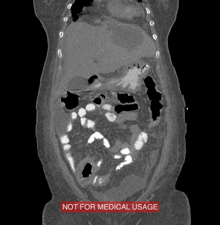 Amoebic enterocolitis with liver abscess (Radiopaedia 35100-36609 B 38).jpg