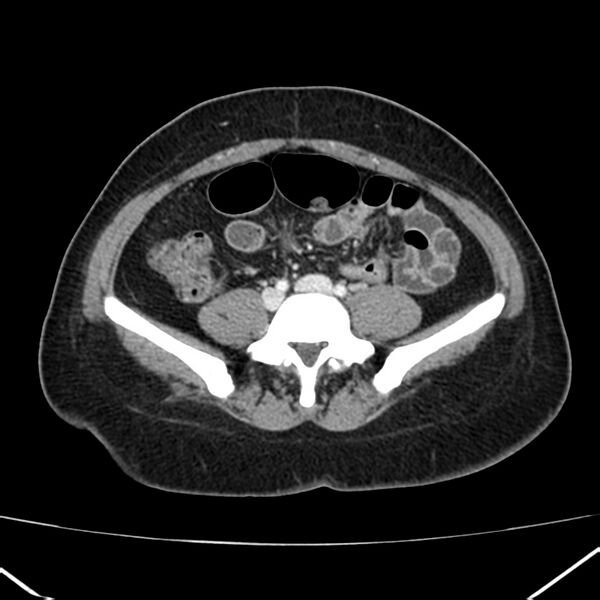File:Ampullary tumor (Radiopaedia 22787-22816 C 45).jpg