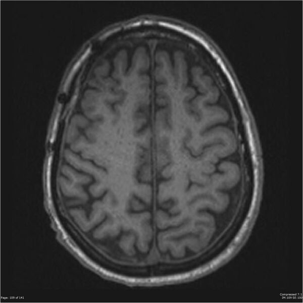 File:Anaplastic meningioma with recurrence (Radiopaedia 34452-35788 Axial T1 107).jpg