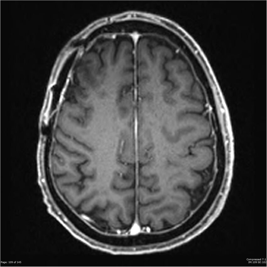 Anaplastic meningioma with recurrence (Radiopaedia 34452-35788 Axial T1 C+ 109).jpg