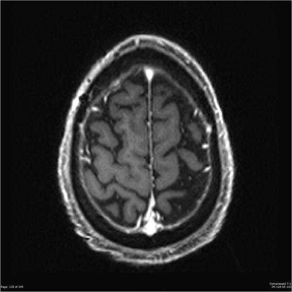 File:Anaplastic meningioma with recurrence (Radiopaedia 34452-35788 Axial T1 C+ 128).jpg