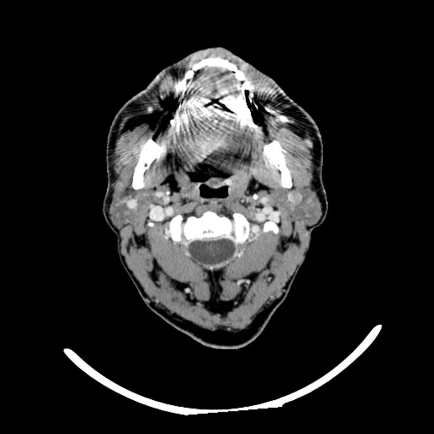 Anaplastic thyroid carcinoma (Radiopaedia 79087-92034 B 97).jpg