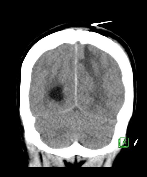 File:Angiomatous meningioma (Radiopaedia 79459-92578 Coronal non-contrast 30).jpg