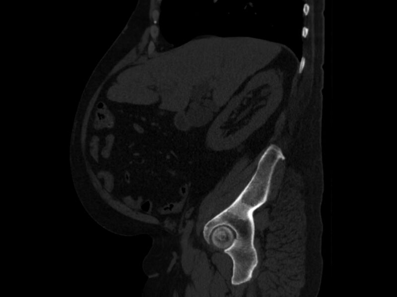 File:Ankylosing spondylitis (Radiopaedia 44609-48357 Sagittal bone window 29).jpg