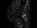 Ankylosing spondylitis (Radiopaedia 44609-48357 Sagittal bone window 65).jpg
