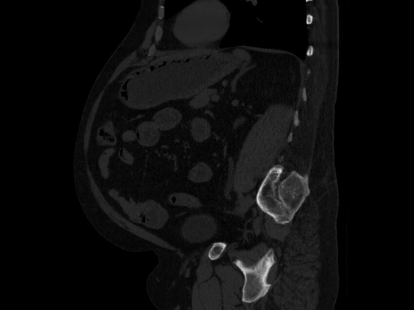 Ankylosing spondylitis (Radiopaedia 44609-48357 Sagittal bone window 71).jpg