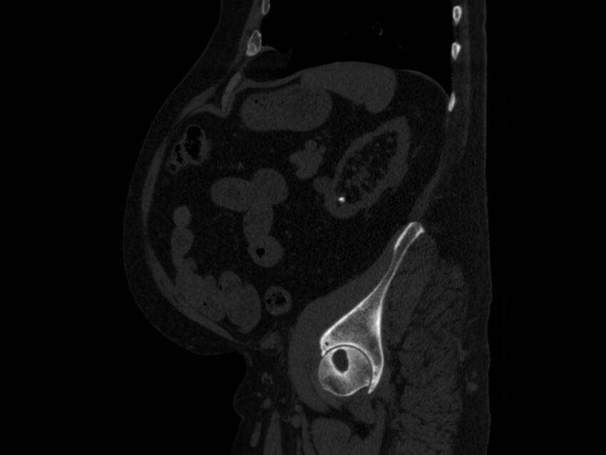 Ankylosing spondylitis (Radiopaedia 44609-48357 Sagittal bone window 85).jpg
