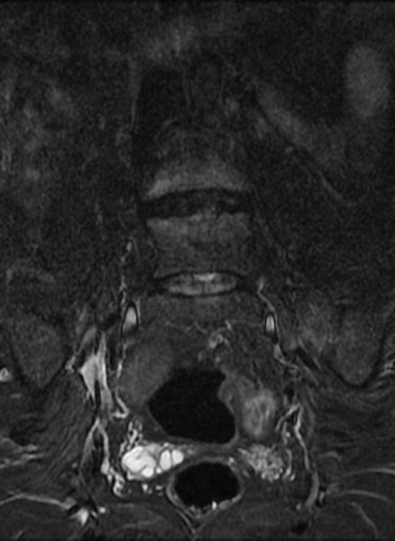 File:Ankylosing spondylitis - Andersson lesion (Radiopaedia 81878-95838 Coronal STIR 4).jpg