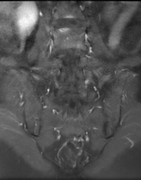 File:Ankylosing spondylitis - Andersson lesion (Radiopaedia 81878-95838 H 9).jpg
