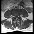 Ankylosing spondylitis with zygapophyseal arthritis (Radiopaedia 38433-40516 Axial T1 9).jpg