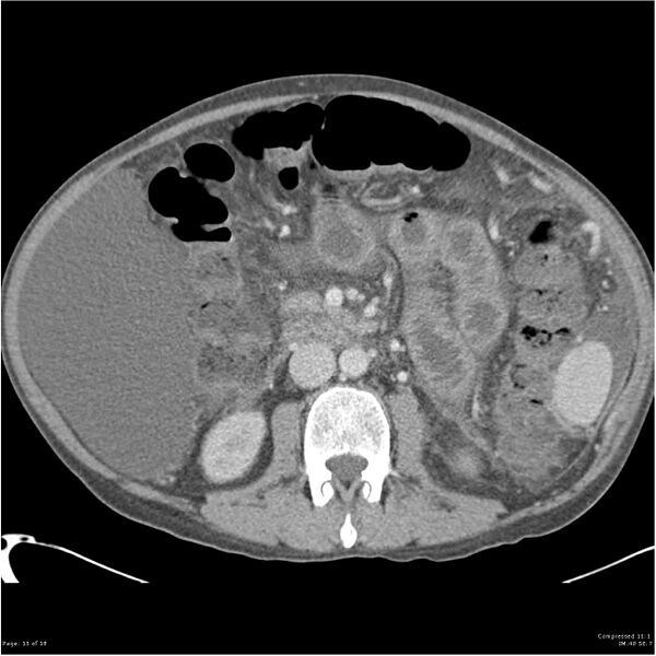 File:Annular pancreas and cirrhosis (Radiopaedia 24561-24843 A 15).jpg
