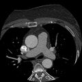 Anomalous origin of left circumflex artery from right coronary sinus (Radiopaedia 72563-83117 B 8).jpg