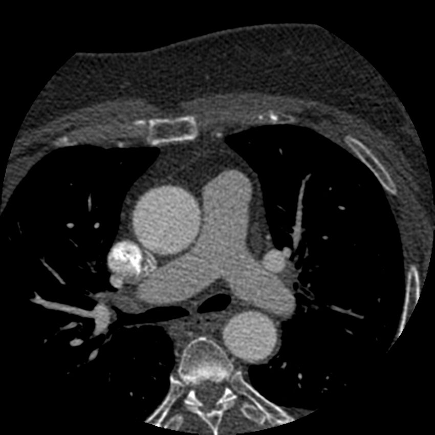 Anomalous origin of left circumflex artery from right coronary sinus (Radiopaedia 72563-83117 B 8).jpg
