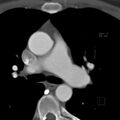 Anomalous right coronary artery (ARCA) with interarterial course (Radiopaedia 12423-12677 B 18).jpg
