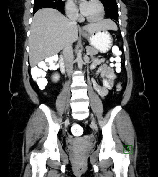 File:Anterior abdominal wall CSF pseudocyst (CSFoma) (Radiopaedia 79453-92571 B 32).jpg