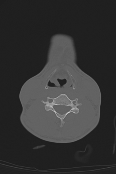 File:Anterior nasal spine fracture (Radiopaedia 46138-50494 Axial bone window 83).png