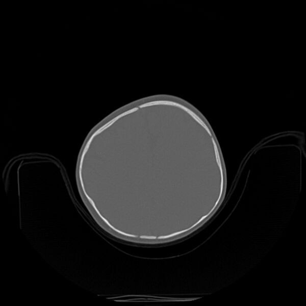 File:Anterior plagiocephaly (Radiopaedia 71836-82273 C 66).jpg