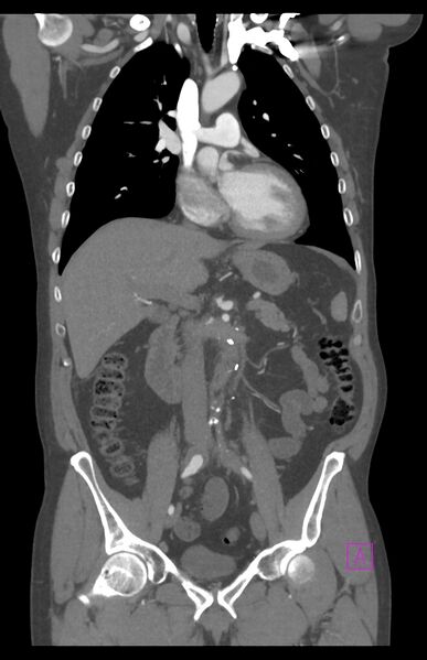 File:Aortectomy and axillary-bifemoral bypass (Radiopaedia 28303-28545 C 44).jpg