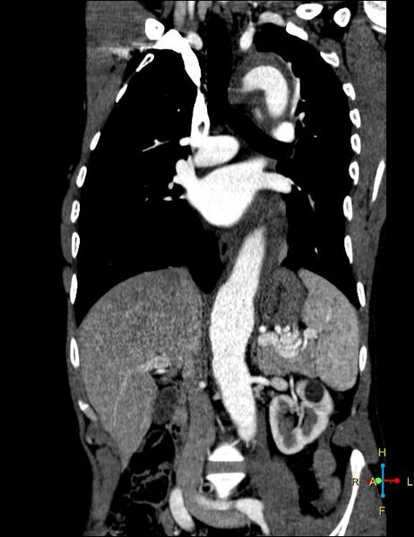 File:Aortic aneurysm and penetrating ulcer (Radiopaedia 23590-23704 B 8).jpg