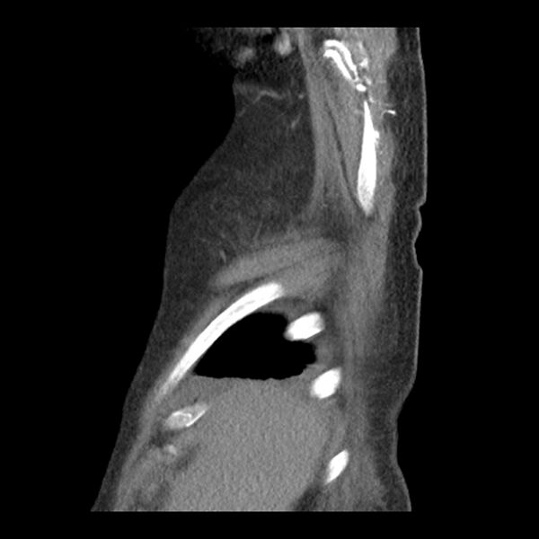 File:Aortic arch graft infection (FDG PET-CT) (Radiopaedia 71975-82437 C 5).jpg