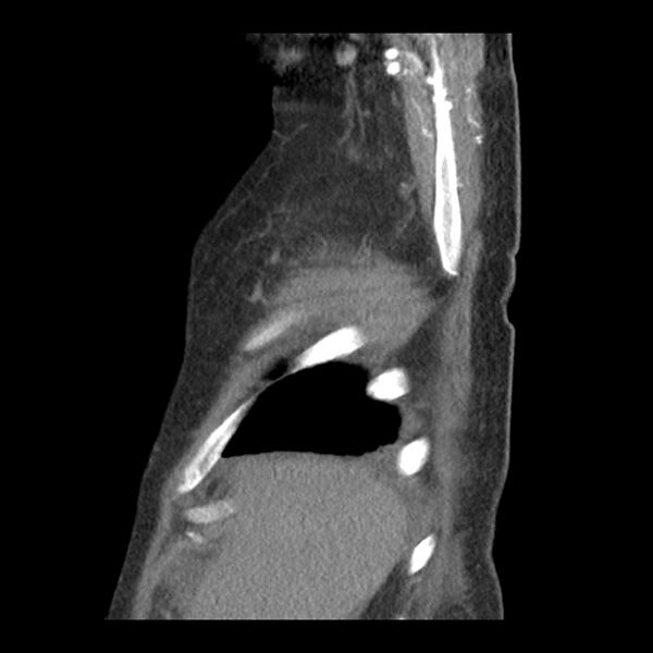File:Aortic arch graft infection (FDG PET-CT) (Radiopaedia 71975-82437 C 6).jpg