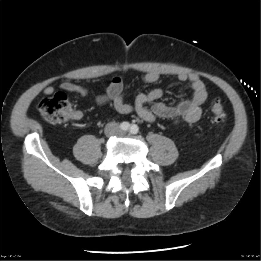 Aortic dissection- Stanford A (Radiopaedia 37759-39664 A 133).jpg