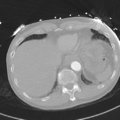 Aortic dissection - DeBakey type II (Radiopaedia 64302-73082 Axial lung window 54).png