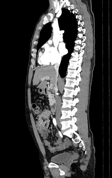 File:Aortic dissection - Stanford type A (Radiopaedia 83418-98500 B 21).jpg