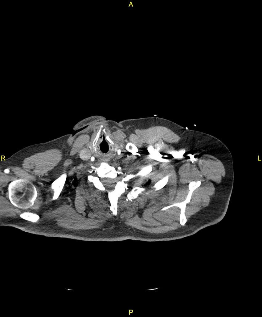 Aortic rupture (Radiopaedia 88822-105594 B 5).jpg