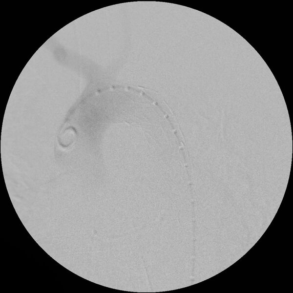 File:Aortic transection and subclavian steal (Radiopaedia 8711-9517 Stent 1).jpg