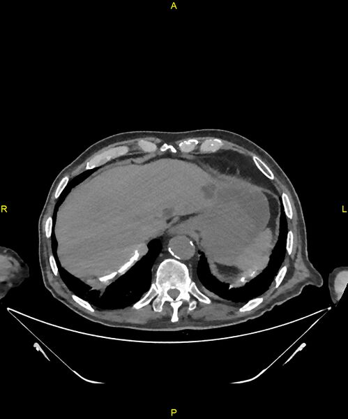 File:Aortoenteric fistula (Radiopaedia 84308-99603 Axial non-contrast 31).jpg