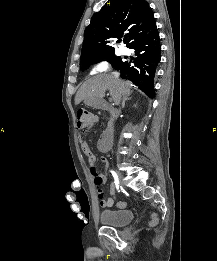 Aortoenteric fistula (Radiopaedia 84308-99603 C 139).jpg