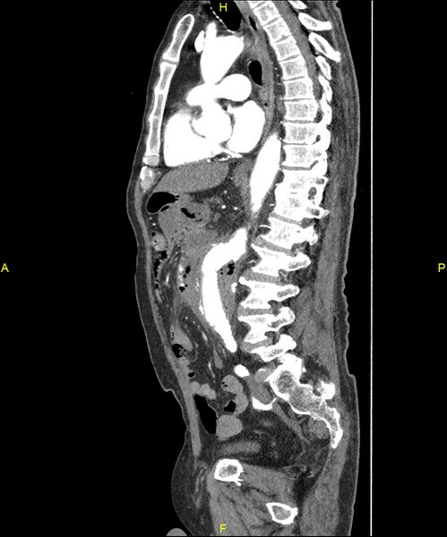 File:Aortoenteric fistula (Radiopaedia 84308-99603 C 195).jpg